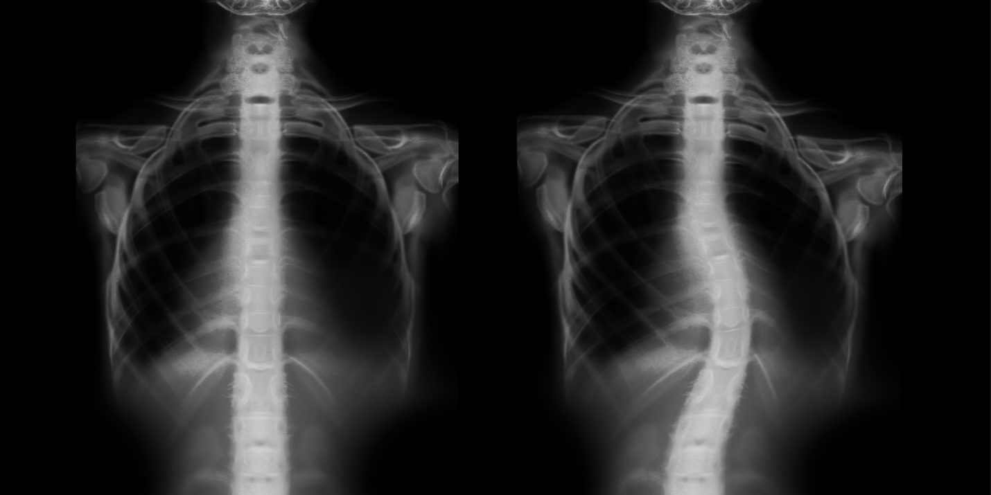 Unveiling the Truth Does Carrying Heavy Items and Bags Cause Scoliosis